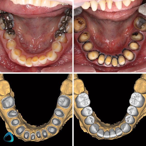 A Digital Approach To A Full Mouth Rehabilitation Institute Of