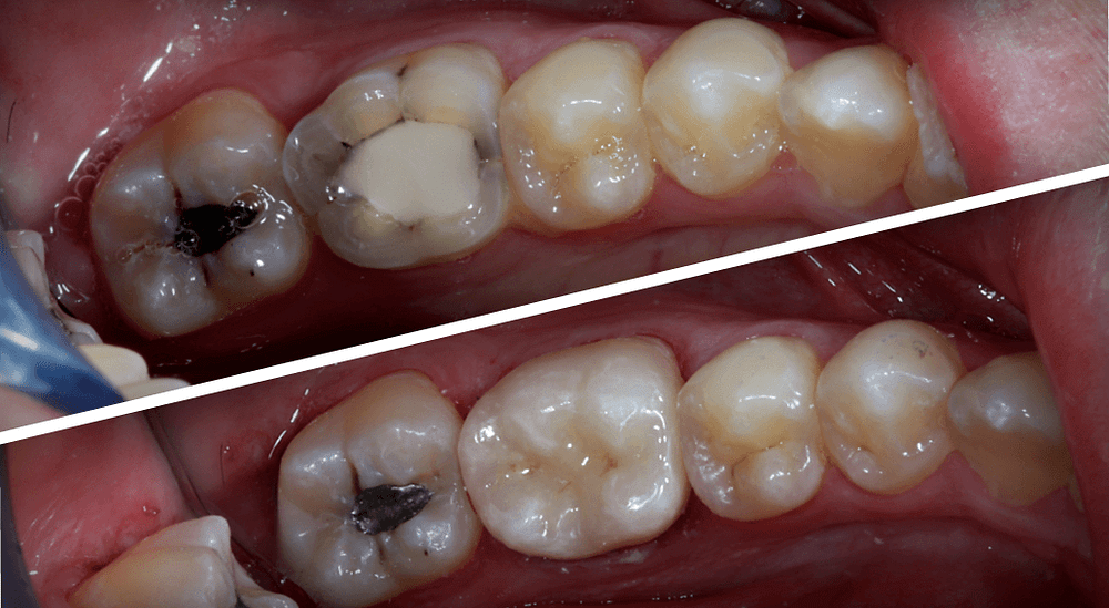 before and after CEREC crown CADCAM same day dentistry emax institute of digital dentistry