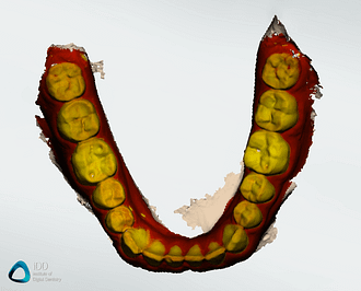caries-detection-trios-4-function-mandibular-arch-institute-of-digital-dentistry