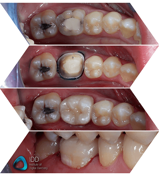 emax crown start to finish glazed and stained ivoclar cadcam institute of digital dentistry