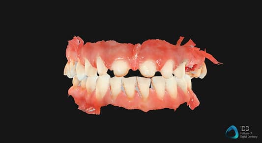 carestream dental full arch scan