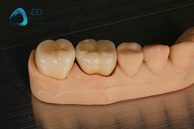 Figure 9. IPS e.max crowns before and after post-processing including ceramic characterisation, glazing and firing.