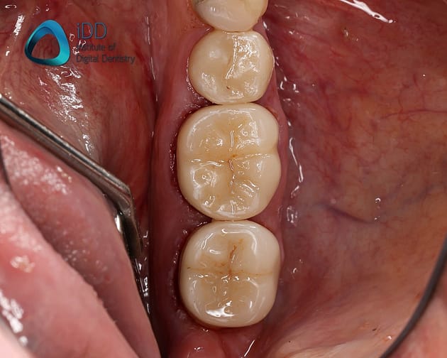 Figure 11. Post-operative photograph. The final ceramic crown restorations are bonded using resin cement.
