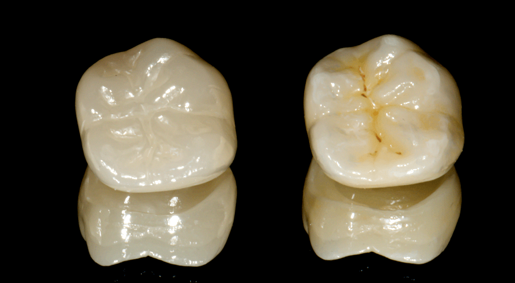 Polishing VS Glazing Dental Ceramics Digital Dentistry Blog iDD