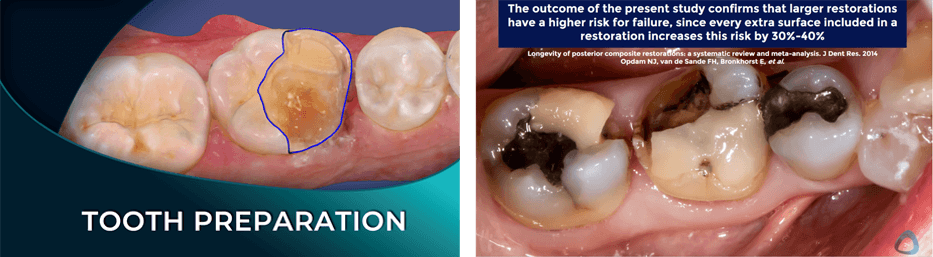 tooth margination and preparation dental online course institute of digital dentistry