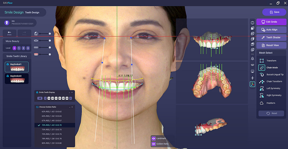 ray face smile design institute of digital dentistry