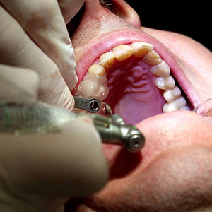 drill-open-mouth-impant-surgery-guide-3d-printed-guided-surgery-nobel-biocare-institute-of-digital-dentistry