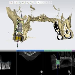 Taking a CBCT X-Ray and how to read, diagnose and use the CBCT in Implant Planning