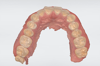 Full-arch-scanning-TRIOS-3SHAPE-TRIOS-4-maxillary-scan-institute-of-digital-dentistry