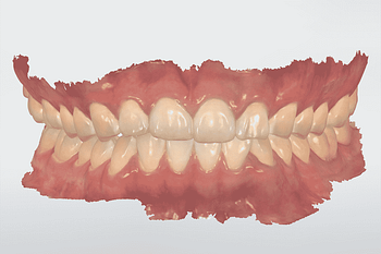 Full-arch-scanning-TRIOS-3SHAPE-TRIOS-4-bite-scan-institute-of-digital-dentistry