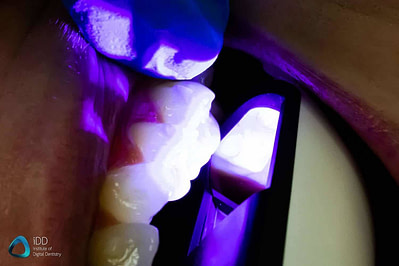 3shape-trios-4-review-caries-detection-function-TRIOS-institute-of-digital-dentistry