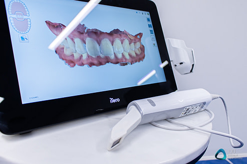 itero_element_5D_plus_intraoral_scanner_review_institute_of_digital_dentistry (46)