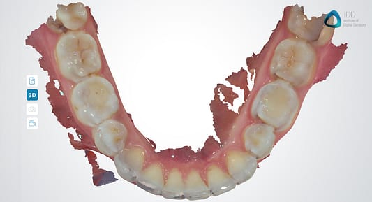 full arch scans dentaLink IOS fussen institute of digital dentistry (2)