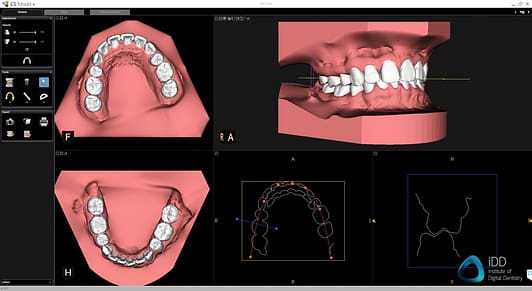 carestream dental cs 3700 model plus software orthodontic simulation institute of digital dentistry 1