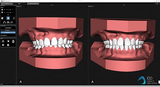 carestream dental cs 3700 model plus software orthodontic simulation institute of digital dentistry 2
