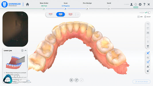 Shining_3D_Aoralscan_3_Review_cost_institute_of_digital_dentistry_ai (69)