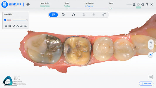 Shining_3D_Aoralscan_3_Review_cost_institute_of_digital_dentistry_ai (98)