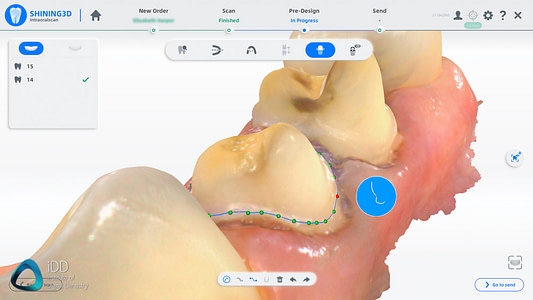 Shining_3D_Aoralscan_3_Review_cost_institute_of_digital_dentistry_ai (92)