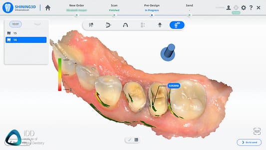 Shining_3D_Aoralscan_3_Review_cost_institute_of_digital_dentistry_ai (93)