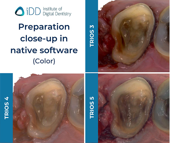iDD-compares-color-zoom-scans-3shape-intraoral-scanner-trios3-trios4-trios5