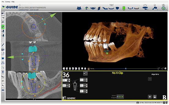 X-Guide Review - Dynamic Navigation for Implantology - iDD