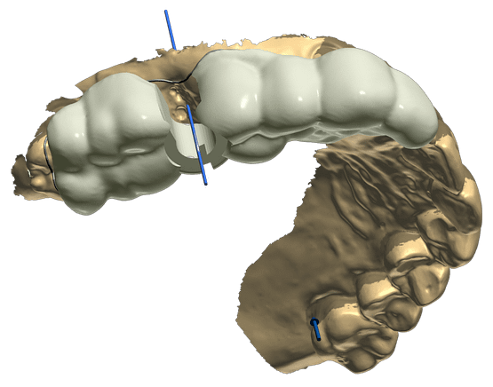 3shape implant