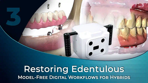 Model-Free Digital Workflows for Edentulous Implant Cases