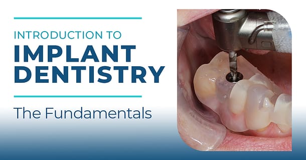 Introduction to Implant Dentistry - The Fundamentals