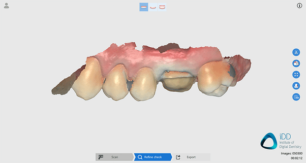 runyes ios scan after processing institute of digital dentistry-2final