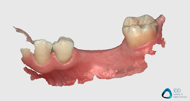 runyes ios scan after processing edentulous scan institute of digital dentistry (2)