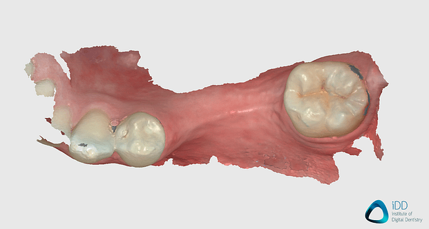 runyes ios scan after processing edentulous scan institute of digital dentistry