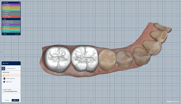 Figure 6. The final CAD design of two ceramic crowns using exocad.