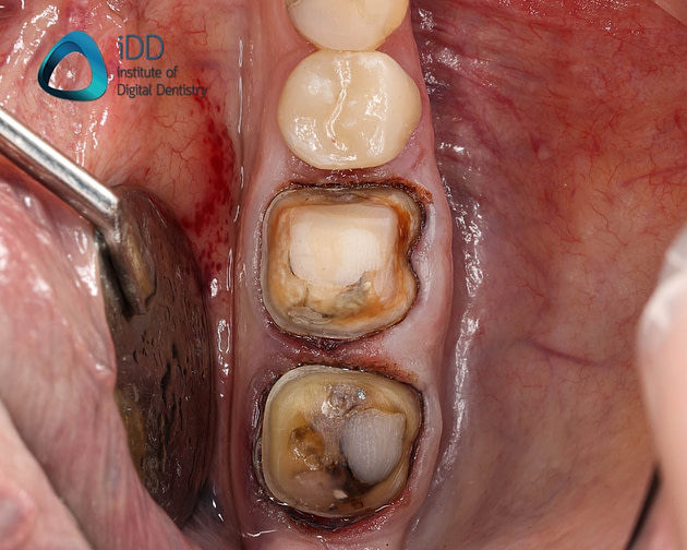 Figure 2. Completed tooth preparations for two IPS e.max ceramic crowns.