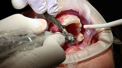 Live Patient Predictable Implant Surgery for Beginners
