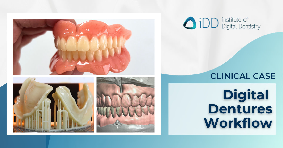 Digital Workflows for Digital Dentures