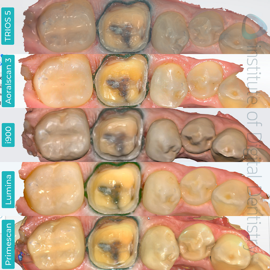 iDD Compares iTero Lumina and Medit i900 vs. Other IOS