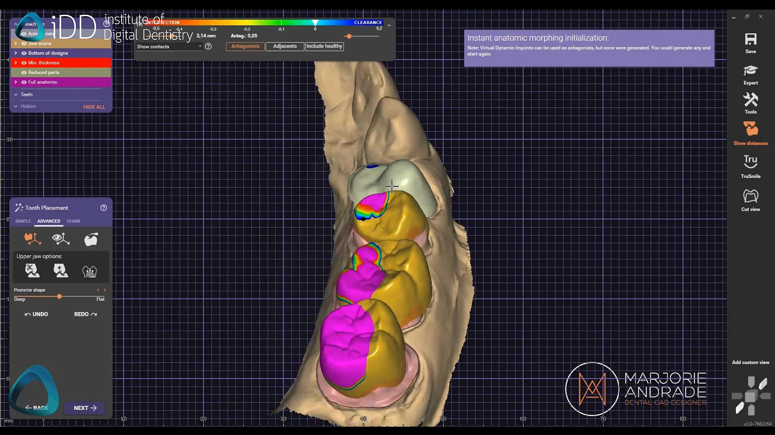 How to 3D Print Dental Crowns with iDD - Institute of Digital Dentistry