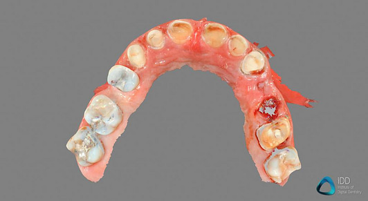 carestream dental full arch scan