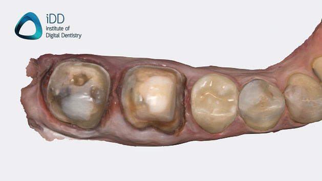 Figure 3. Intraoral scan taken using the Medit i700 Wireless.