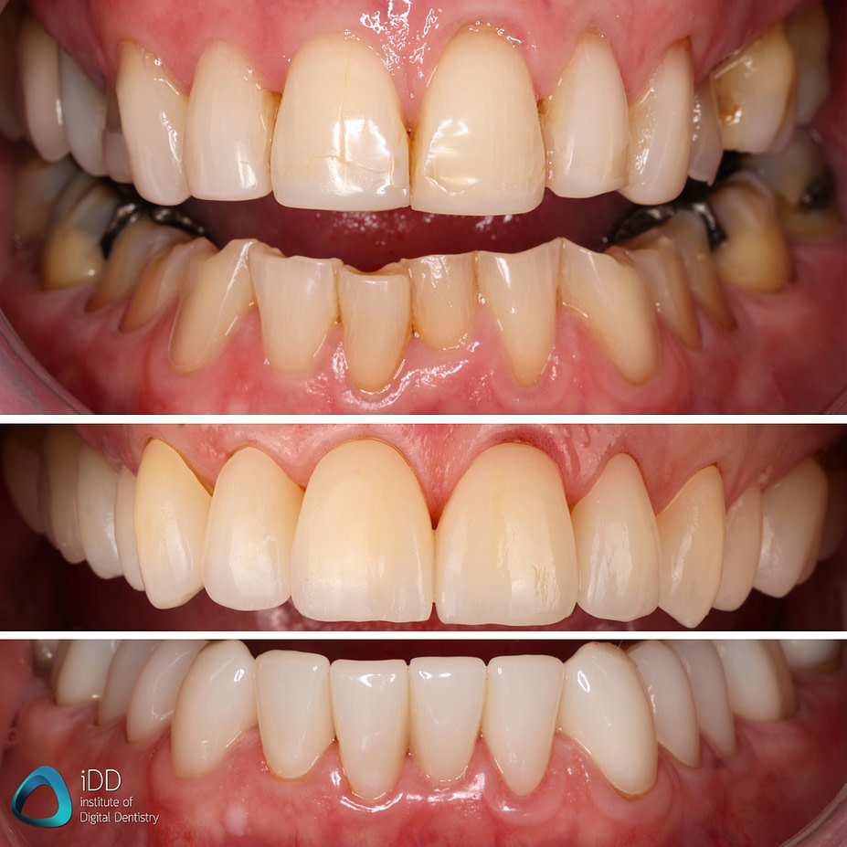 A Digital Approach To A Full Mouth Rehabilitation Institute Of A Digital Approach To A Full Mouth Rehabilitation Institute Of