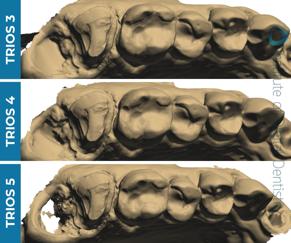 iDD-compares-monochrome-scans-3shape-intraoral-scanner-trios3-trios4-trios5