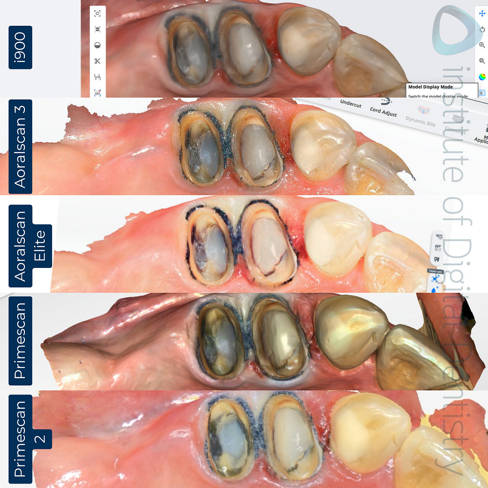 intraoral-scanner-comparison-idd-compares-institute-of-digital-dentistry-blog-native-software-color-scan