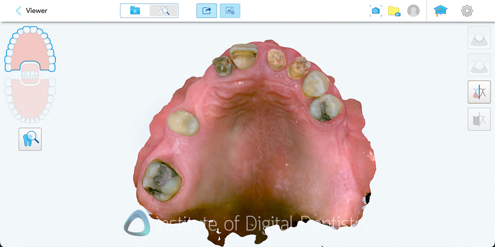 iTero Lumina Intraoral Scanner Review | Institute of Digital Dentistry