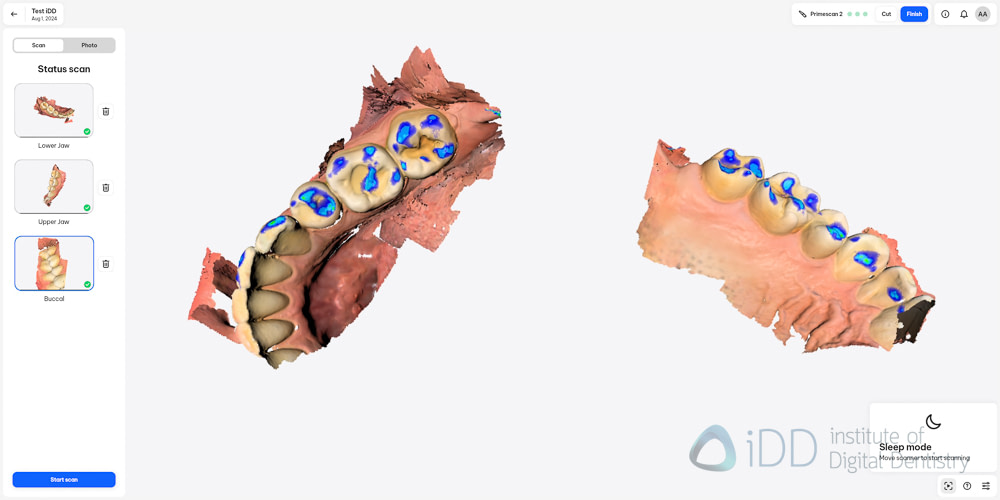 primescan_2_software_scan_caries6