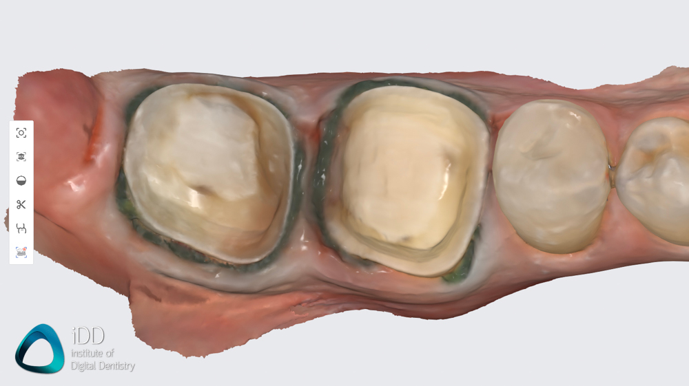 medit_i900_review_scanner_software_IDD (9)