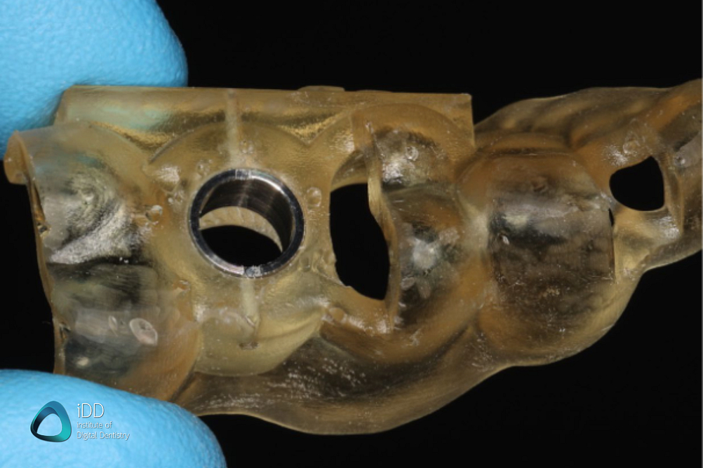 idd-3d-printed-surgical-guides-workflow-before-autoclave