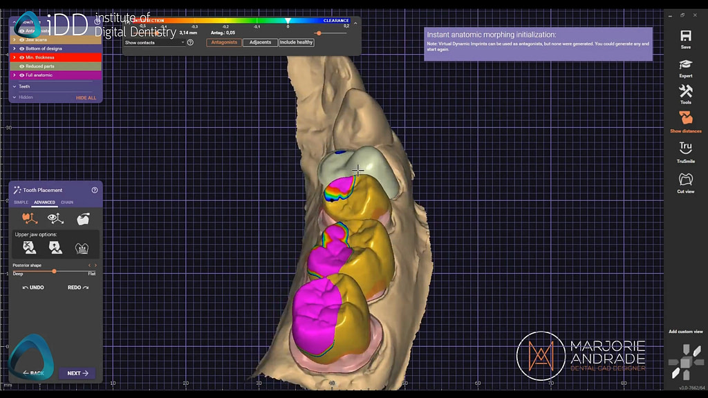 idd-3d-printing-dental-crowns-exocad-design-cad-software