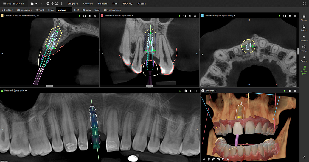 dexis_3800_DTX_studio_clinic_iDD_review_digital_dentistry4