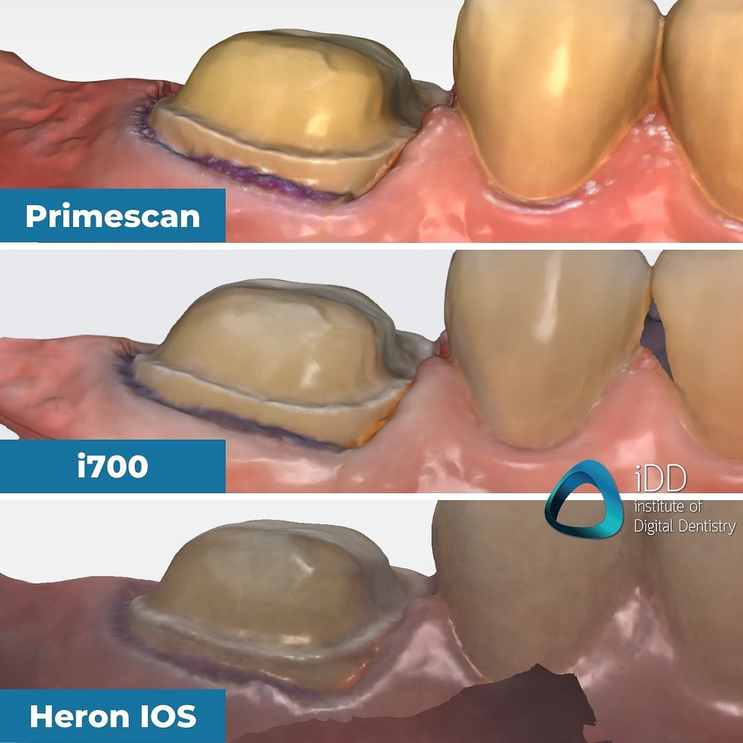 04-close-ups-of-the-mesial-buccal-margin-idd-compares-intraoral-scanners-expensive-vs-cheap-compared-cerec-primescan-vs-medit-i700-vs-heron-ios