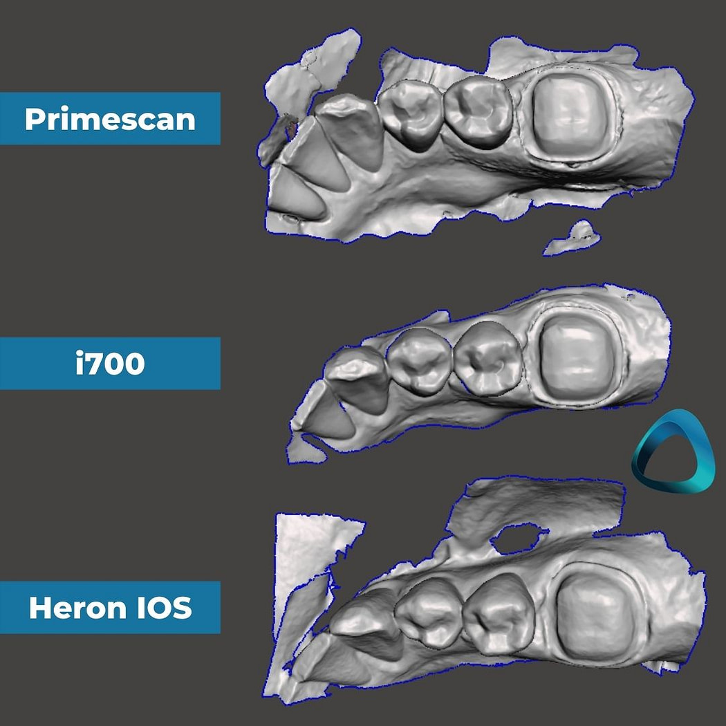 06-unedited-and-untrimmed-quadrant-scans-idd-compares-intraoral-scanners-expensive-vs-cheap-compared-cerec-primescan-vs-medit-i700-vs-heron-ios